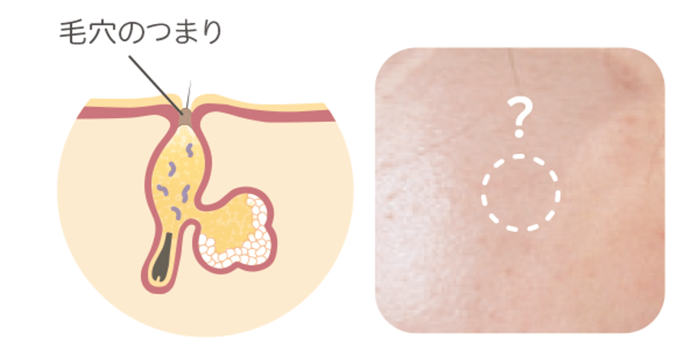 マイクロコメド