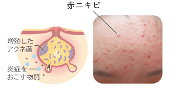 赤ニキビ