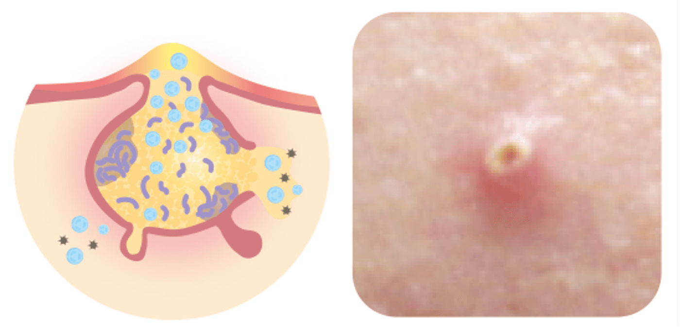 化膿したニキビ