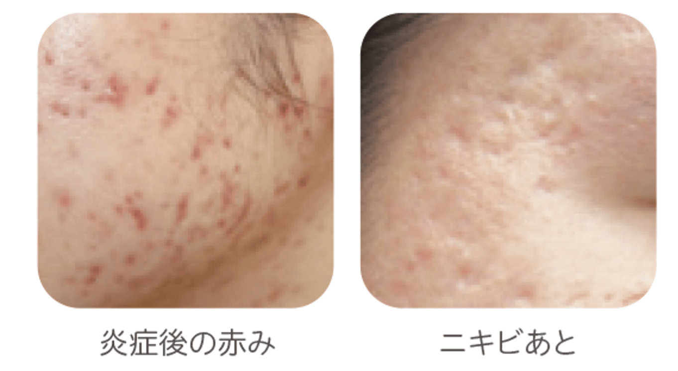 化膿したニキビ