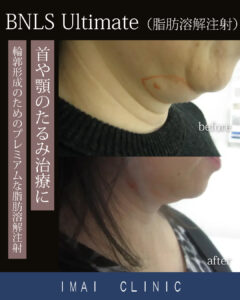 BNLS（1ヶ月後）