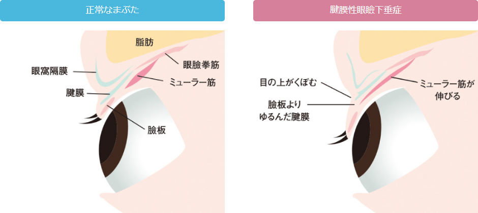 正常なまぶたと眼瞼下垂症