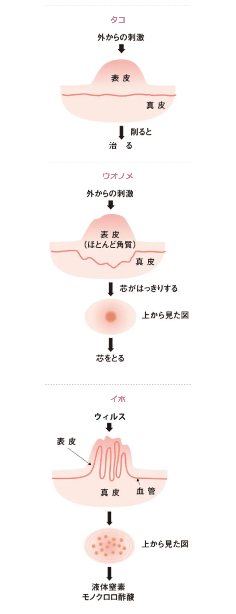 ウィルス性イボ | 立川駅北口 今井皮フ形成外科クリニック