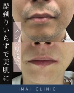 ヒゲ