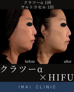 クラツーα＋ウルトラセル