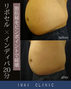 施術前 → 照射2ヶ月後のBefore & After