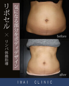 施術前 → 照射2ヶ月後のBefore & After