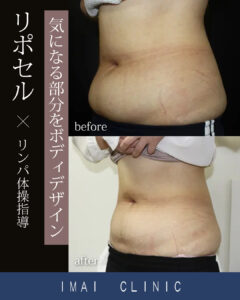 施術前 → 照射2ヶ月後のBefore & After