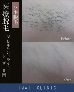 医療脱毛治療法の症例一覧 | 立川駅北口 今井皮フ形成外科クリニック