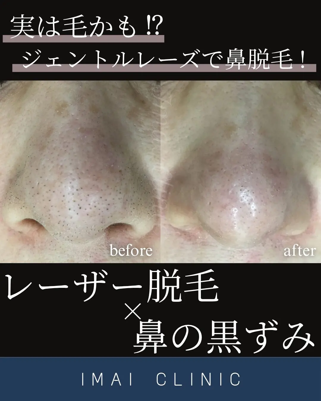 フォトエピ 美顔 エステ レーザー 脱毛 顔脱毛は立川駅北口 今井皮フ形成外科（東京都立川市）
