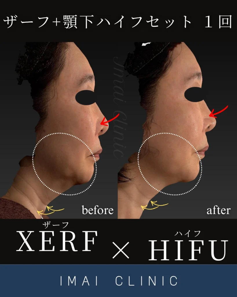 XERF（ザーフ）は立川駅北口 今井皮フ形成外科（東京都立川市）