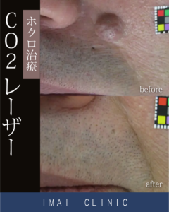 ホクロ