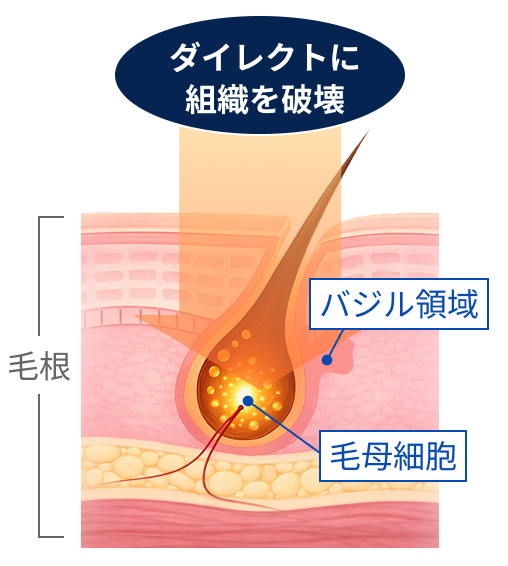 ダイレクトに組織を破壊