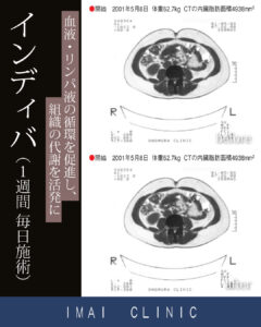1週間 毎日施術時のBefore & After