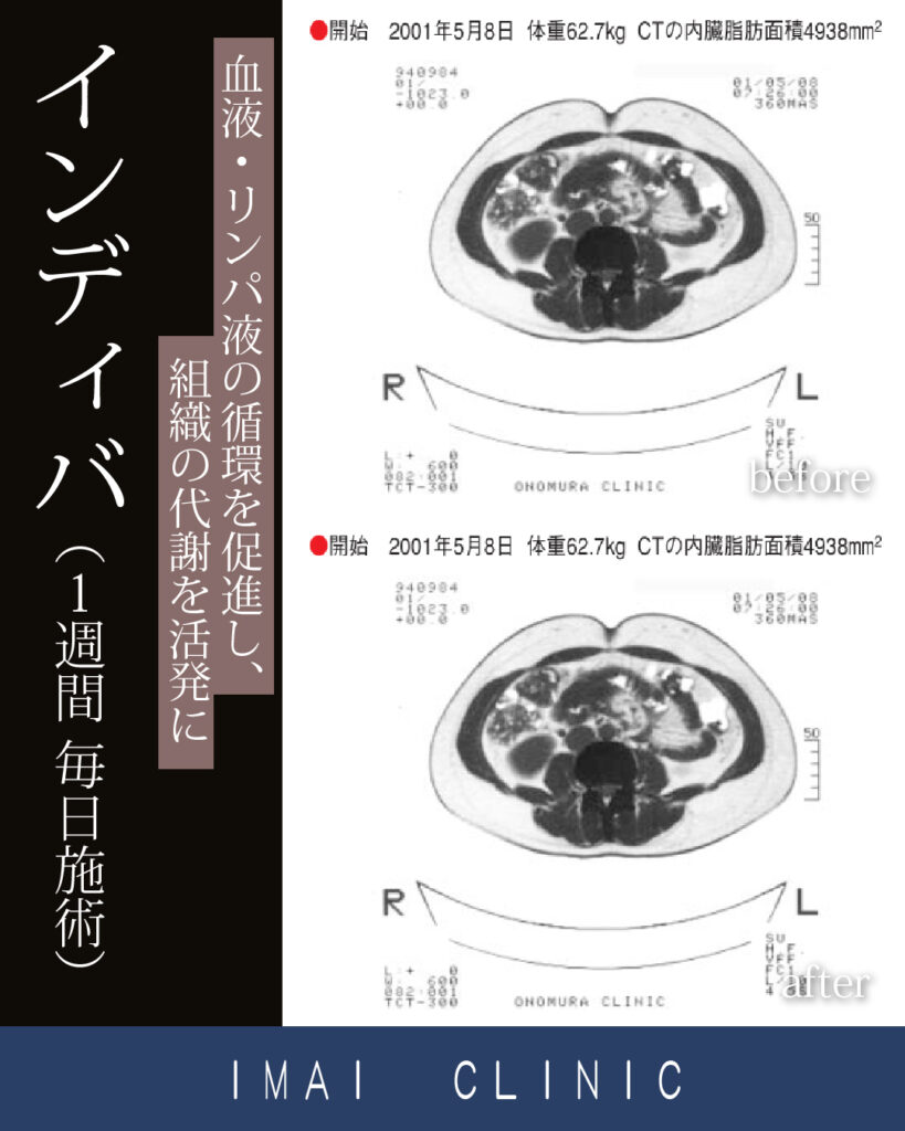 1週間 毎日施術時のBefore & After