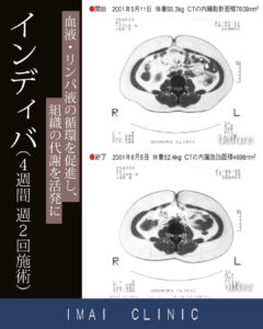 4週間 週2回施術時のBefore & After
