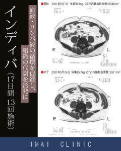 17日間 13回施術時のBefore & After