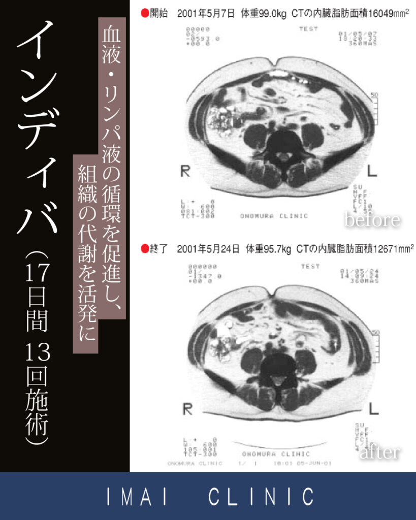 インディバ症例画像