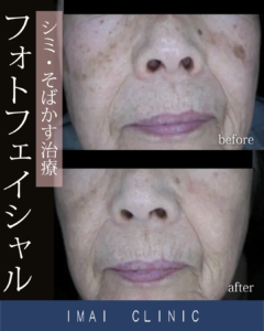 フォトフェイシャル症例画像①