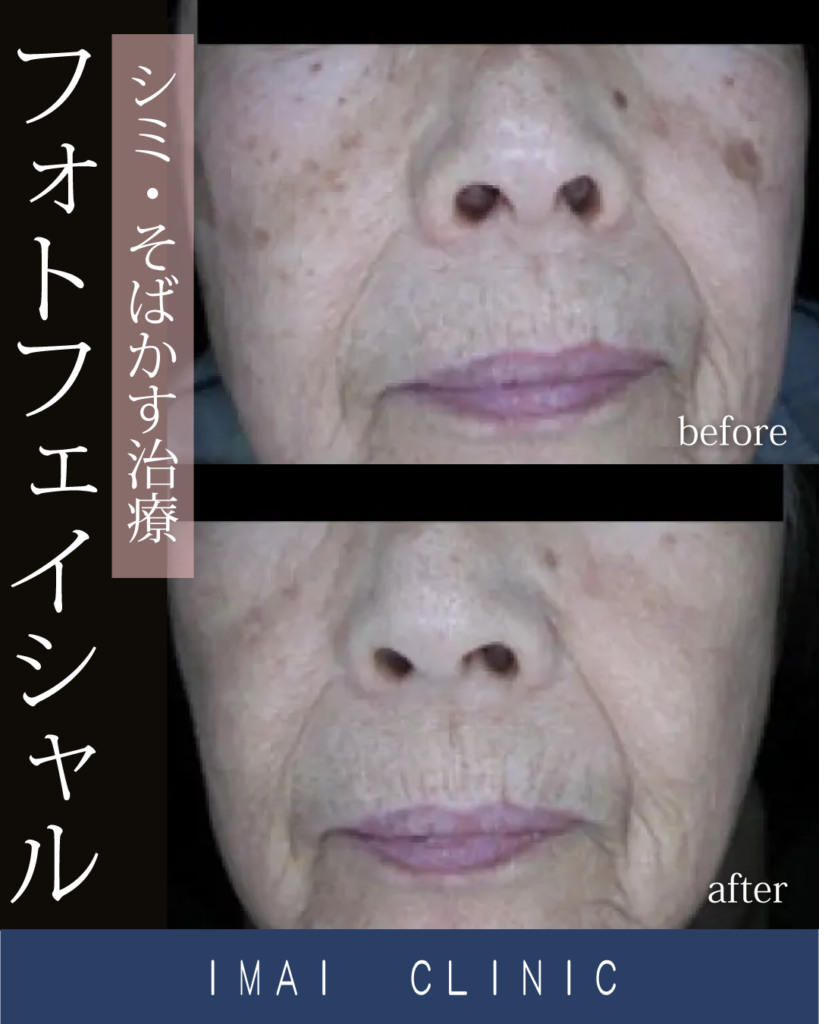 フォトフェイシャル症例画像①
