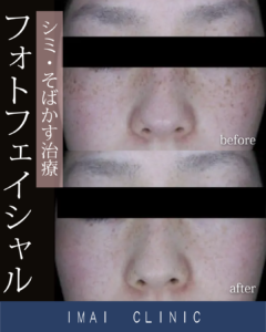 フォトフェイシャル症例画像②