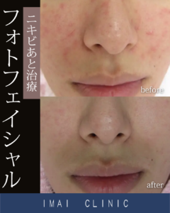 フォトフェイシャル症例画像④