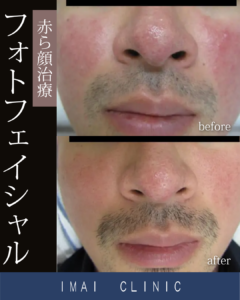 フォトフェイシャル症例画像③