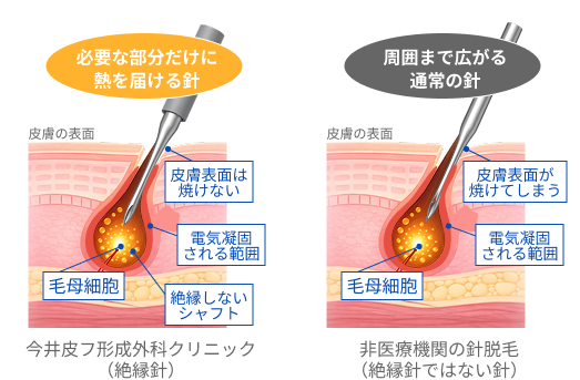 ニードル脱毛比較