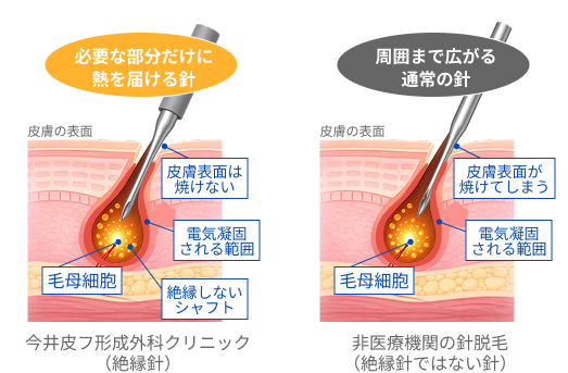 医療脱毛 | 立川駅北口 今井皮フ形成外科クリニック