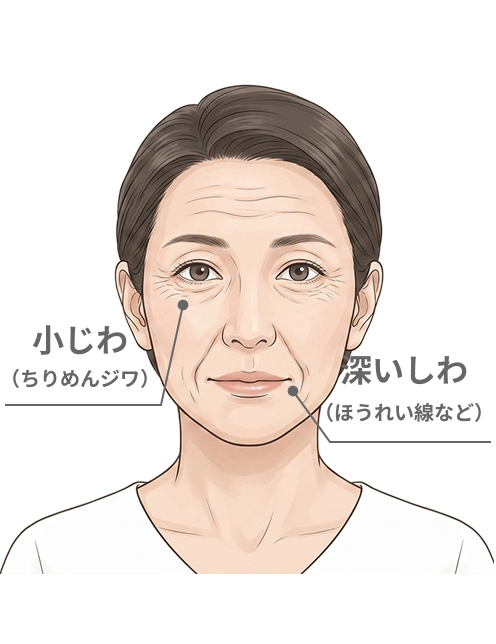  安静時のシワ（じっとしている時のシワ）