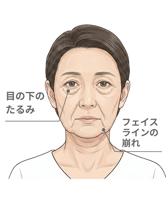 たるみ