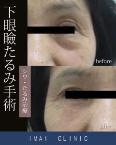 下眼瞼たるみ手術