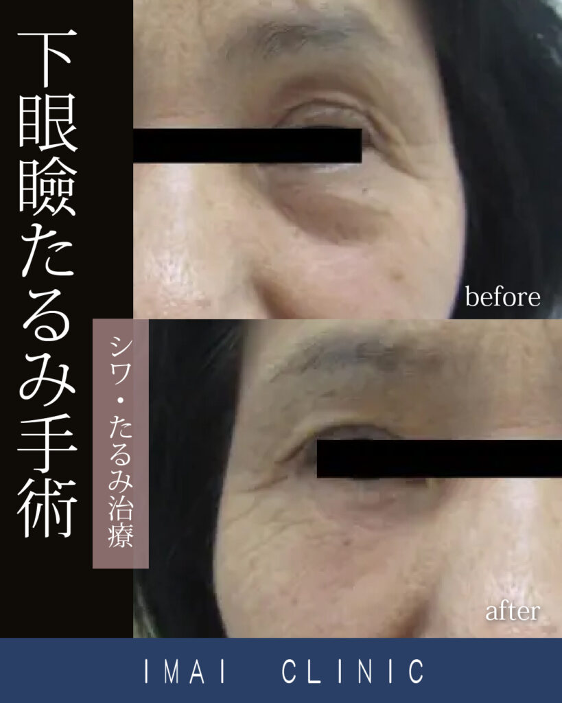 下眼瞼たるみ手術