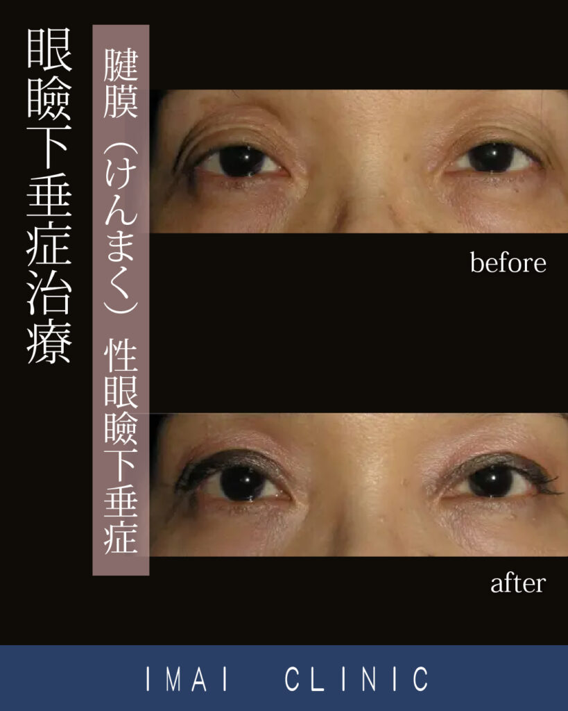 眼瞼下垂症治療①