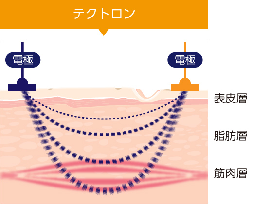 テクトロン（医療用EMS）| 今井皮フ形成外科クリニック