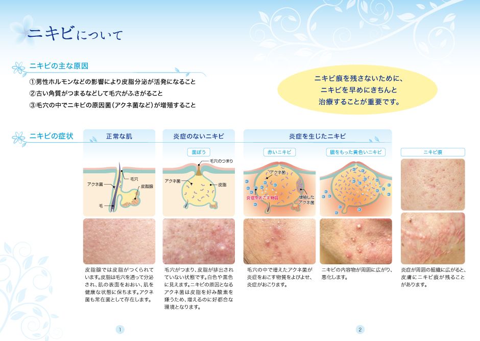 黒 ニキビ 治し 方