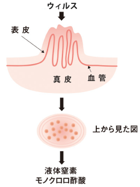 足 裏 イボ 液体 窒素