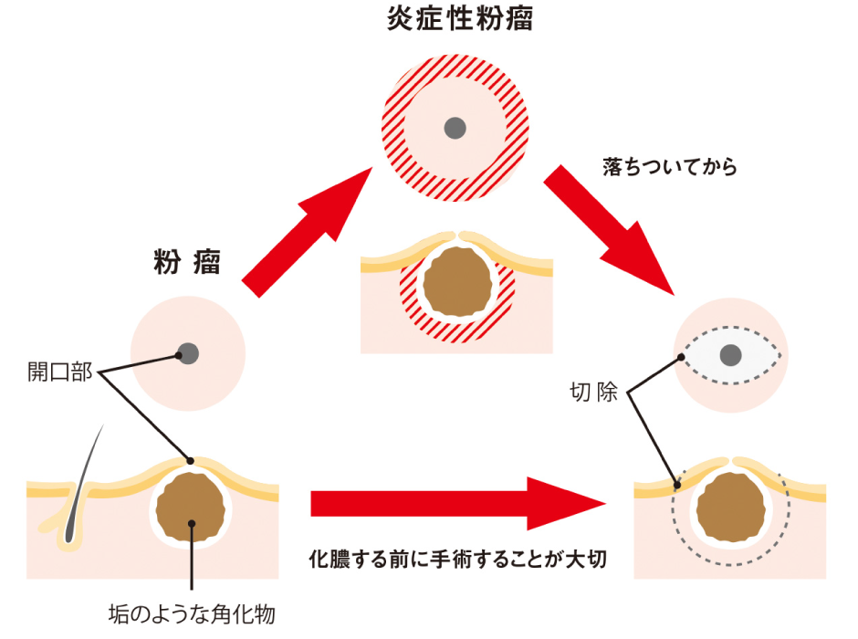 粉 瘤 と 脂肪 腫 の 違い