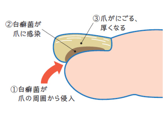 爪白癬 つめはくせん 今井皮フ形成外科クリニック